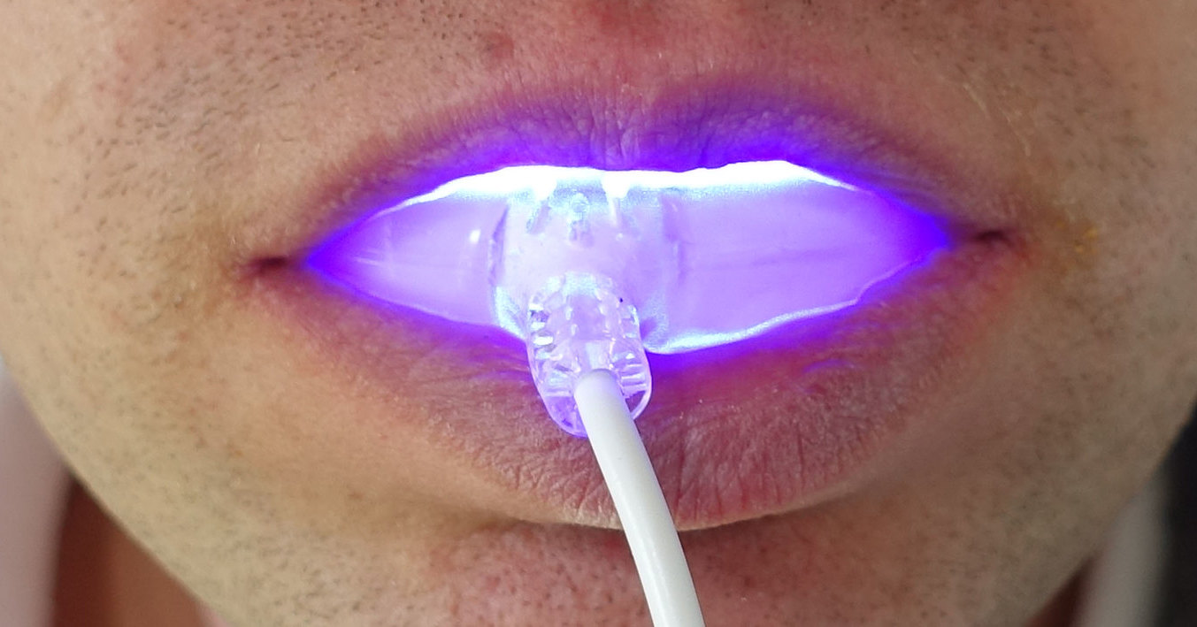 Laser Teeth Whitening Kits At Home: How To Win Buyers And Influence Sales