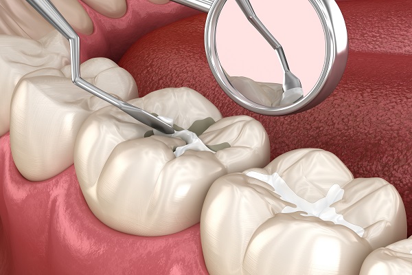 Dental Sealants: Procedure, Benefits, and Care