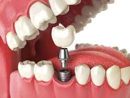 Top 10 Benefits of Dental Implants