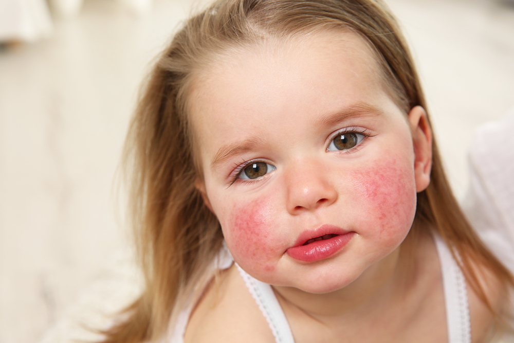 Common Allergies In Children